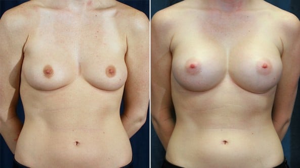 Before and After Image: Breast Augmentation - front