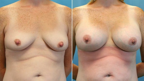 Before and After Image: Breast Augmentation - front