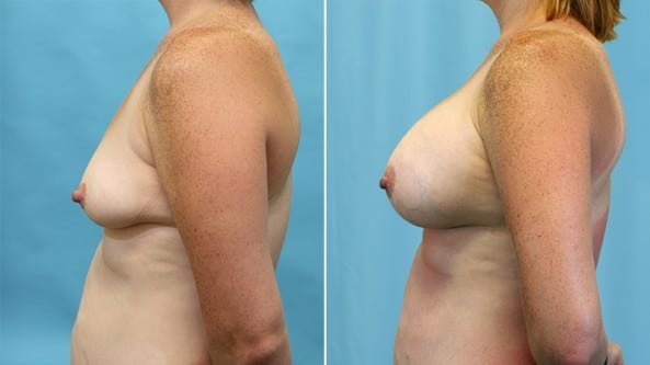 Before and After Image: Breast Augmentation - left-side