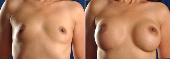 Before and After Image: Breast Augmentation - front