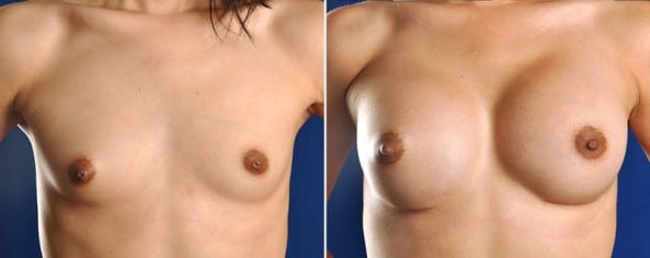 Before and After Image: Breast Augmentation - front