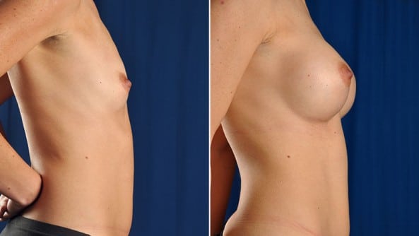 Before and After Image: Breast Augmentation - right-side