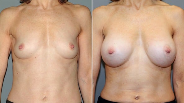 Before and After Image: Breast Augmentation - left-side