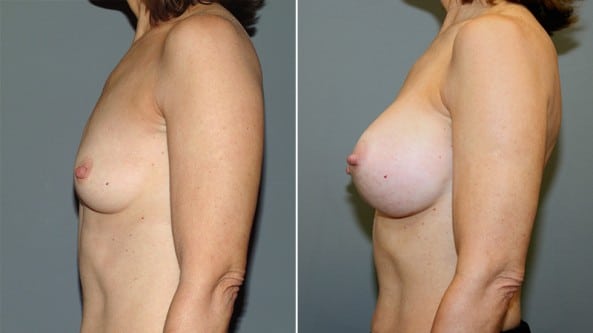 Before and After Image: Breast Augmentation - left-side