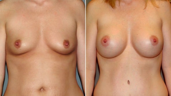 Before and After Image: Breast Augmentation - front