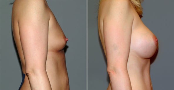 Before and After Image: Breast Augmentation - right-side