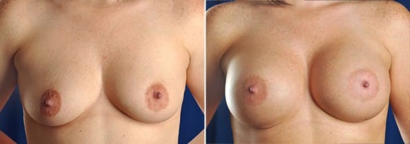 Before and After Image: Breast Augmentation - front