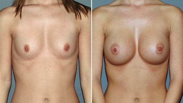 Before and After Image: Breast Augmentation - front