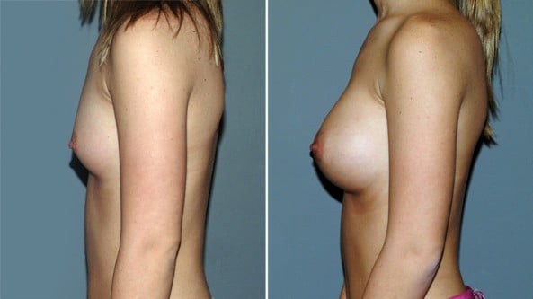 Before and After Image: Breast Augmentation - left-side