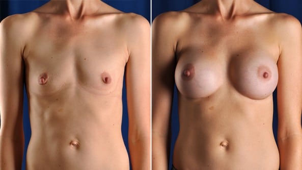 Before and After Image: Breast Augmentation - front
