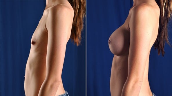 Before and After Image: Breast Augmentation - left-side