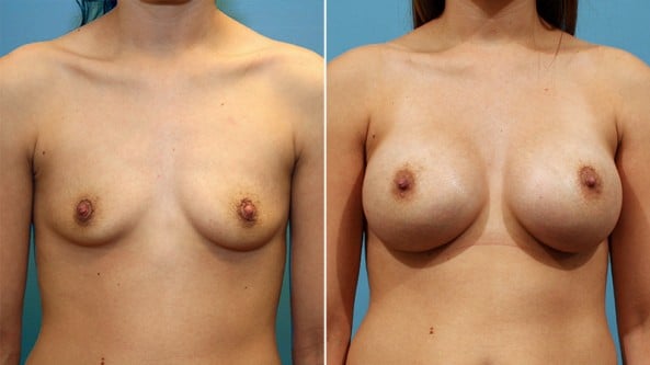 Before and After Image: Breast Augmentation - front