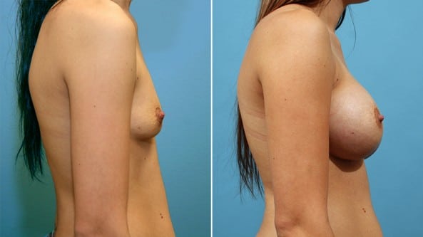 Before and After Image: Breast Augmentation - right-side