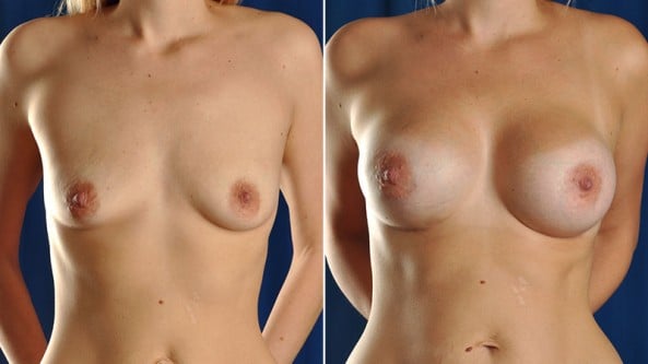 Before and After Image: Breast Augmentation - front