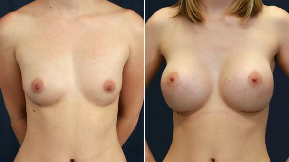 Before and After Image: Breast Augmentation - front