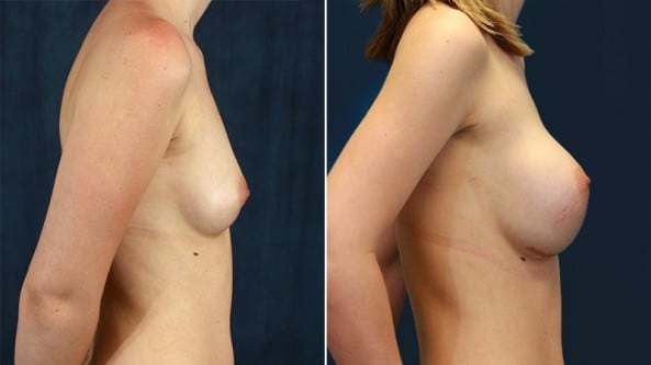 Before and After Image: Breast Augmentation - right-side