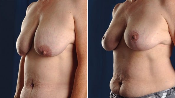 Before and After Image: Breast Lift - left-front-oblique