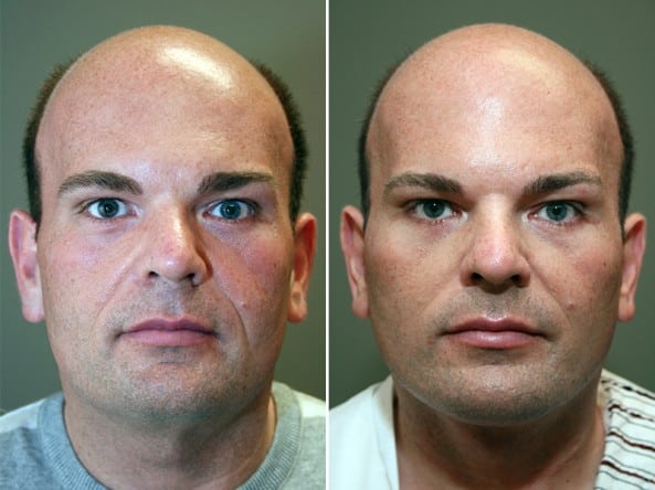 Before and After Image: Facelift - front