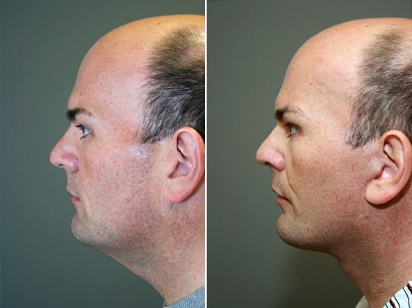 Before and After Image: Facelift - left-side