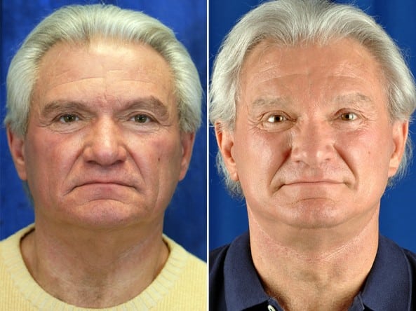 Before and After Image: Facelift - front