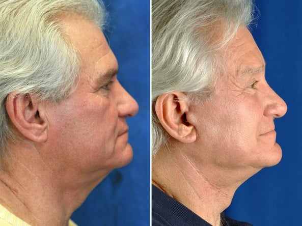 Before and After Image: Facelift - right-side