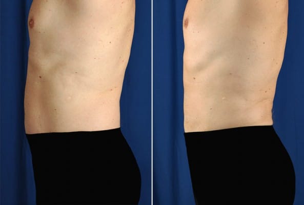 Before and After Image: Liposuction - left-side