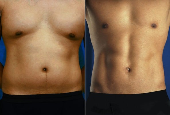 Before and After Image: Liposuction - front