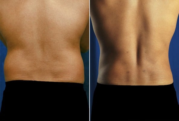 Before and After Image: Liposuction - back