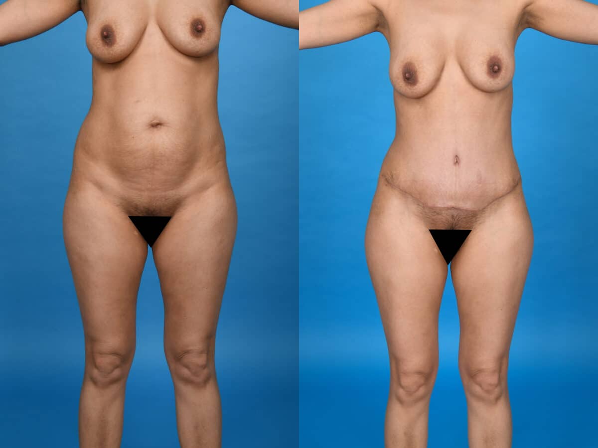 Before and After Image: Liposuction - front