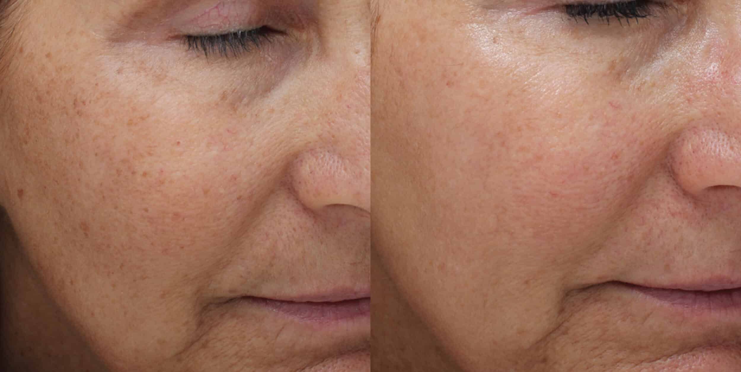 Before and After Image: Moxi + BBL Photofacial - right-front-oblique