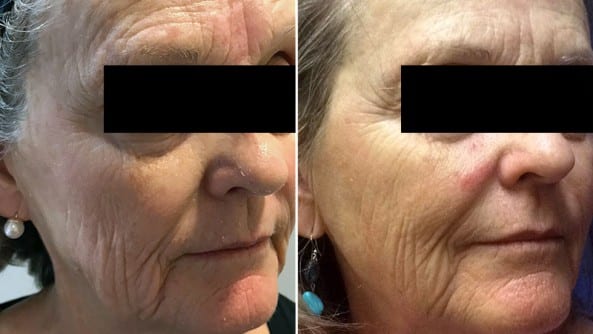 Before and After Image: BBL Photofacial/Halo - right-front-oblique
