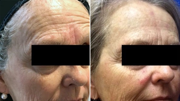 Before and After Image: BBL Photofacial/Halo - right-front-oblique
