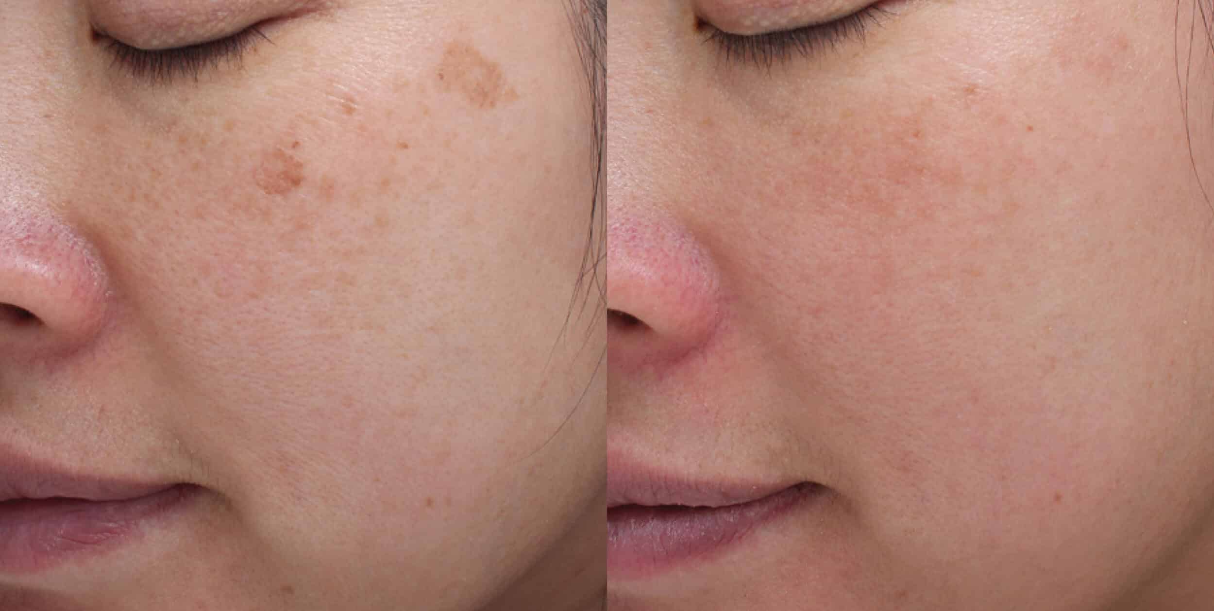 Before and After Image: Moxi + BBL Photofacial - left-front-oblique