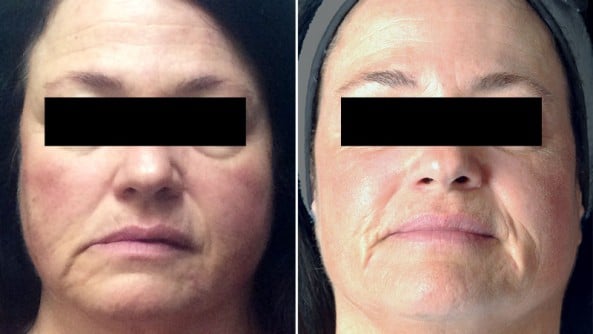 Before and After Image: BBL Photofacial/Halo/SkinTyte - front