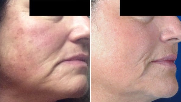 Before and After Image: BBL Photofacial/Halo/SkinTyte - right-front-oblique