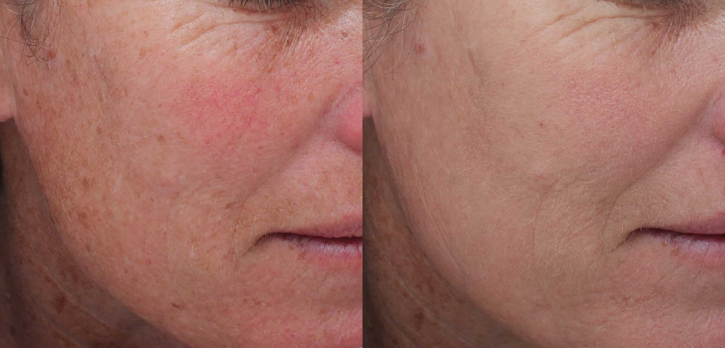 Before and After Image: Moxi + BBL Photofacial - right-front-oblique