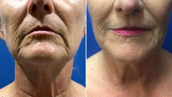 Before and After Image: BBL Photofacial/Halo/SkinTyte - front