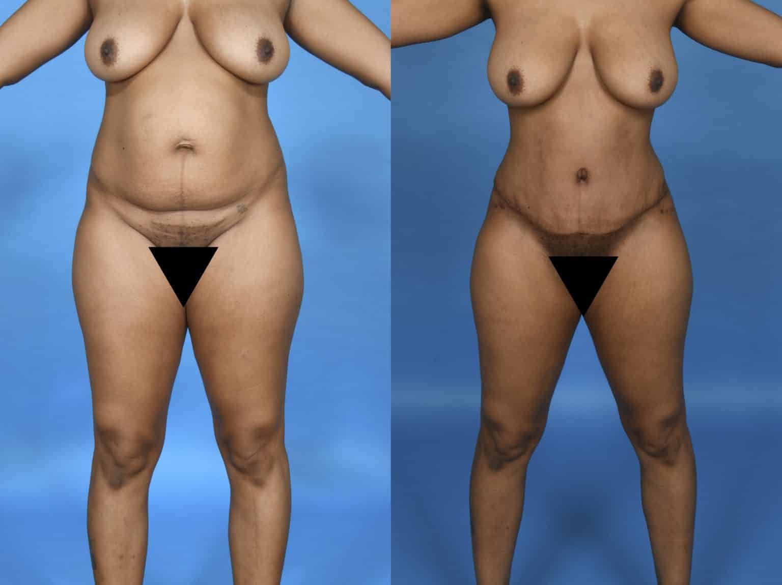 Before and After Image: Body Contouring - front