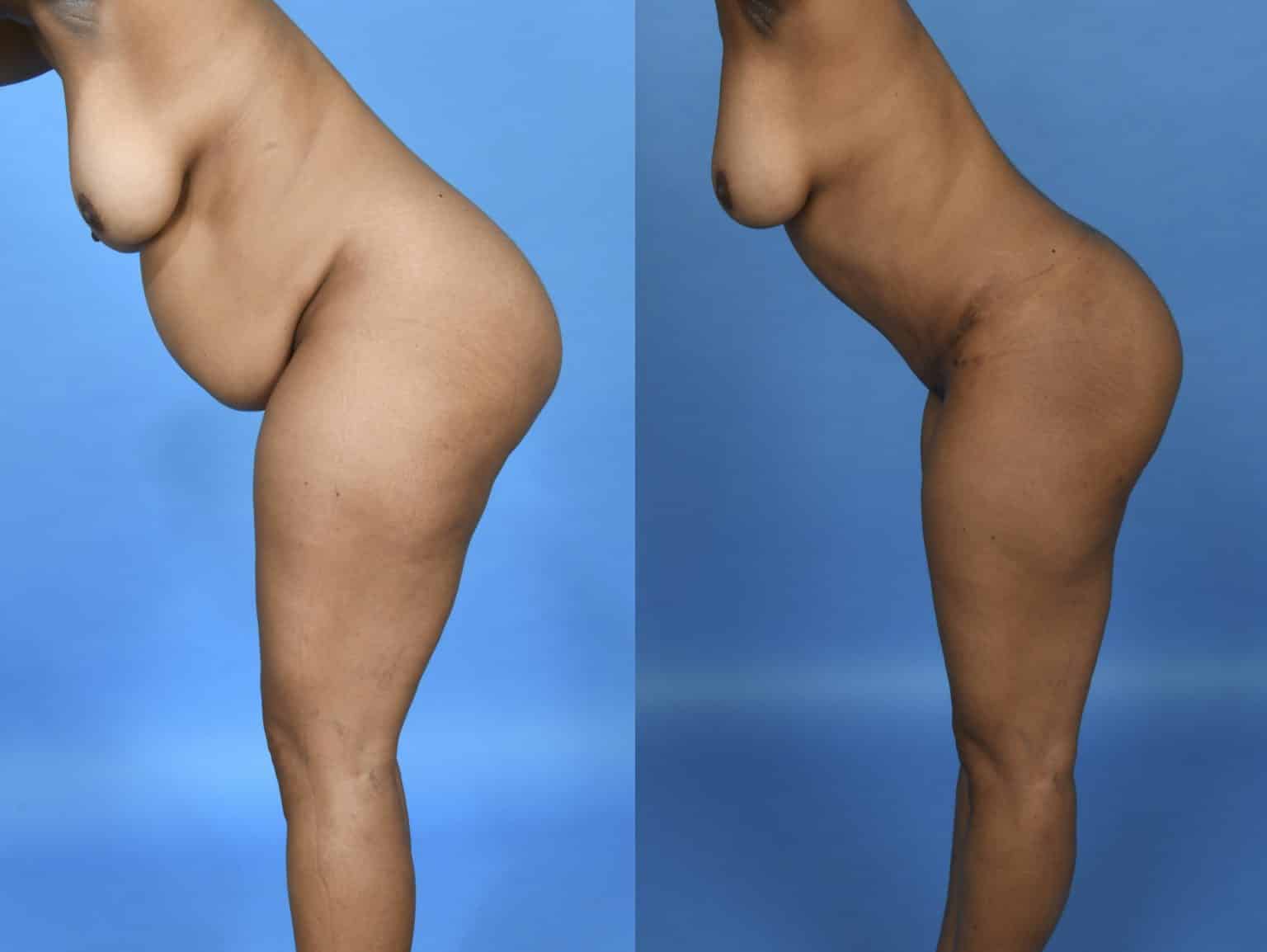 Before and After Image: Body Contouring - other