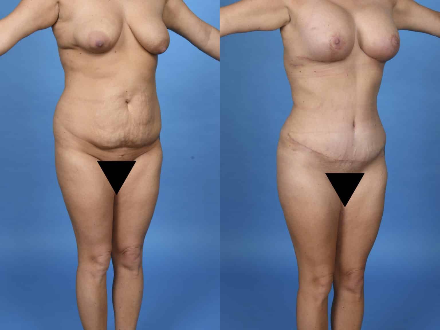 Before and After Image: Body Contouring - right-front-oblique