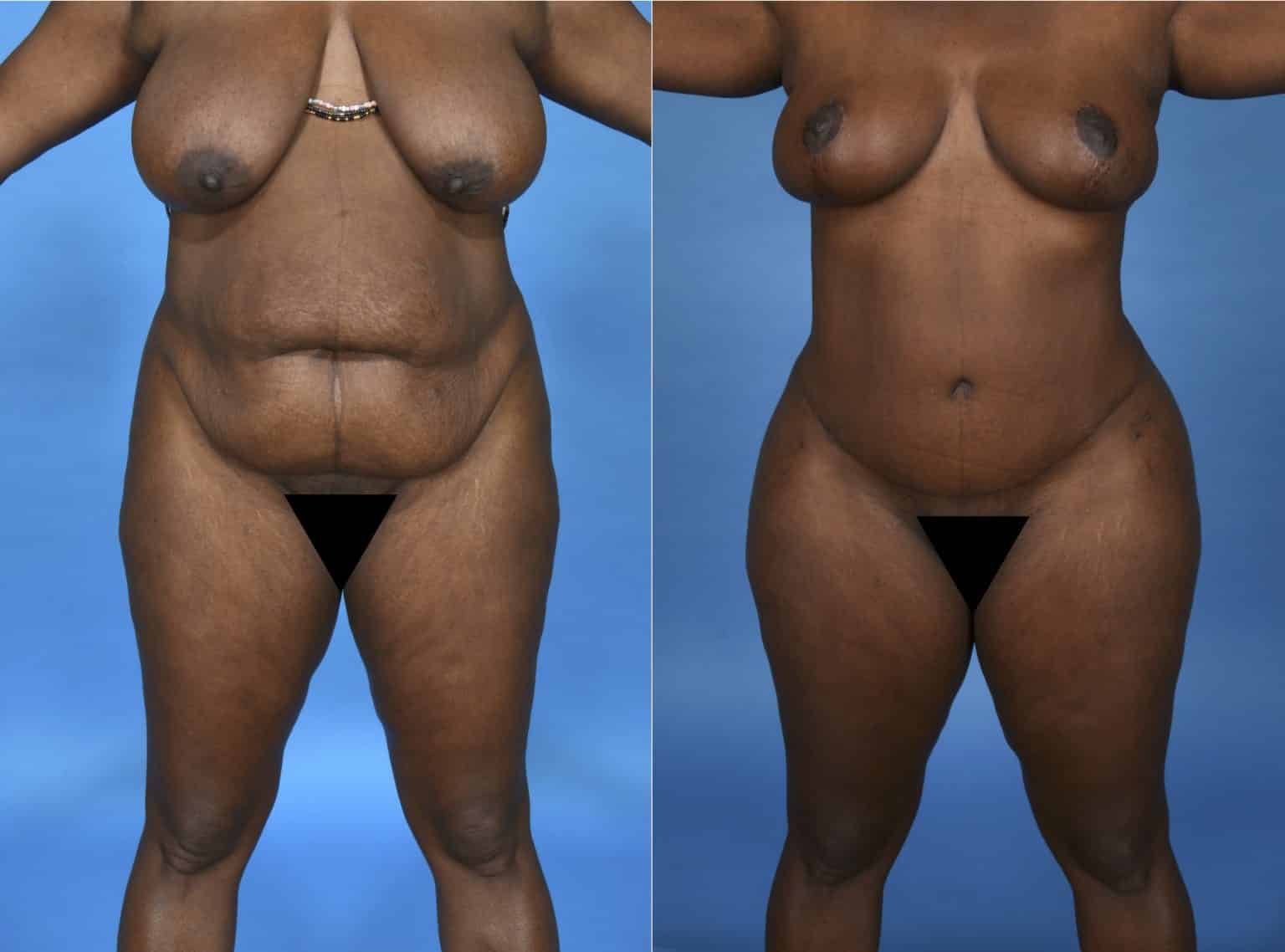 Before and After Image: Body Contouring - front