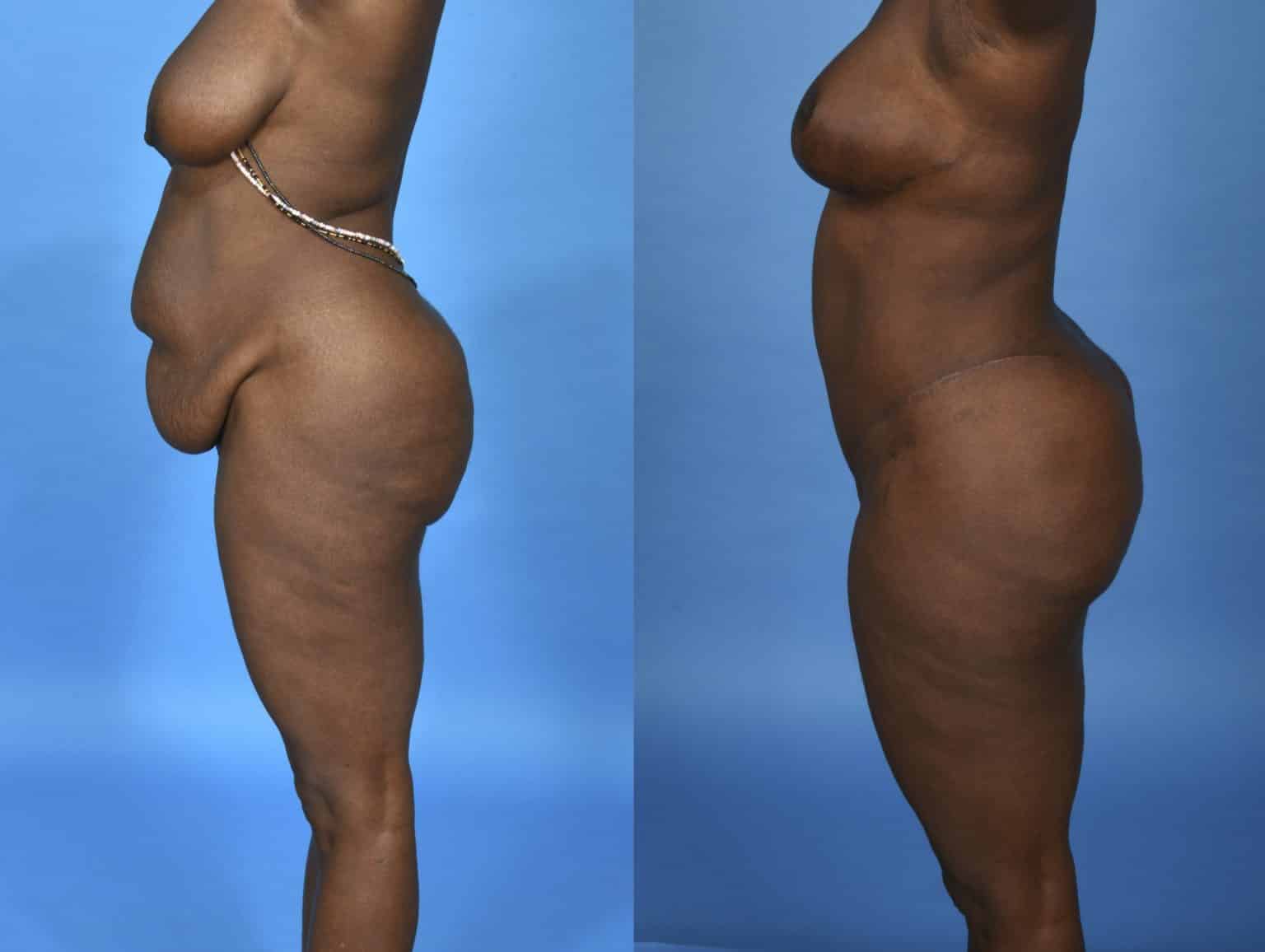 Before and After Image: Body Contouring - left-side