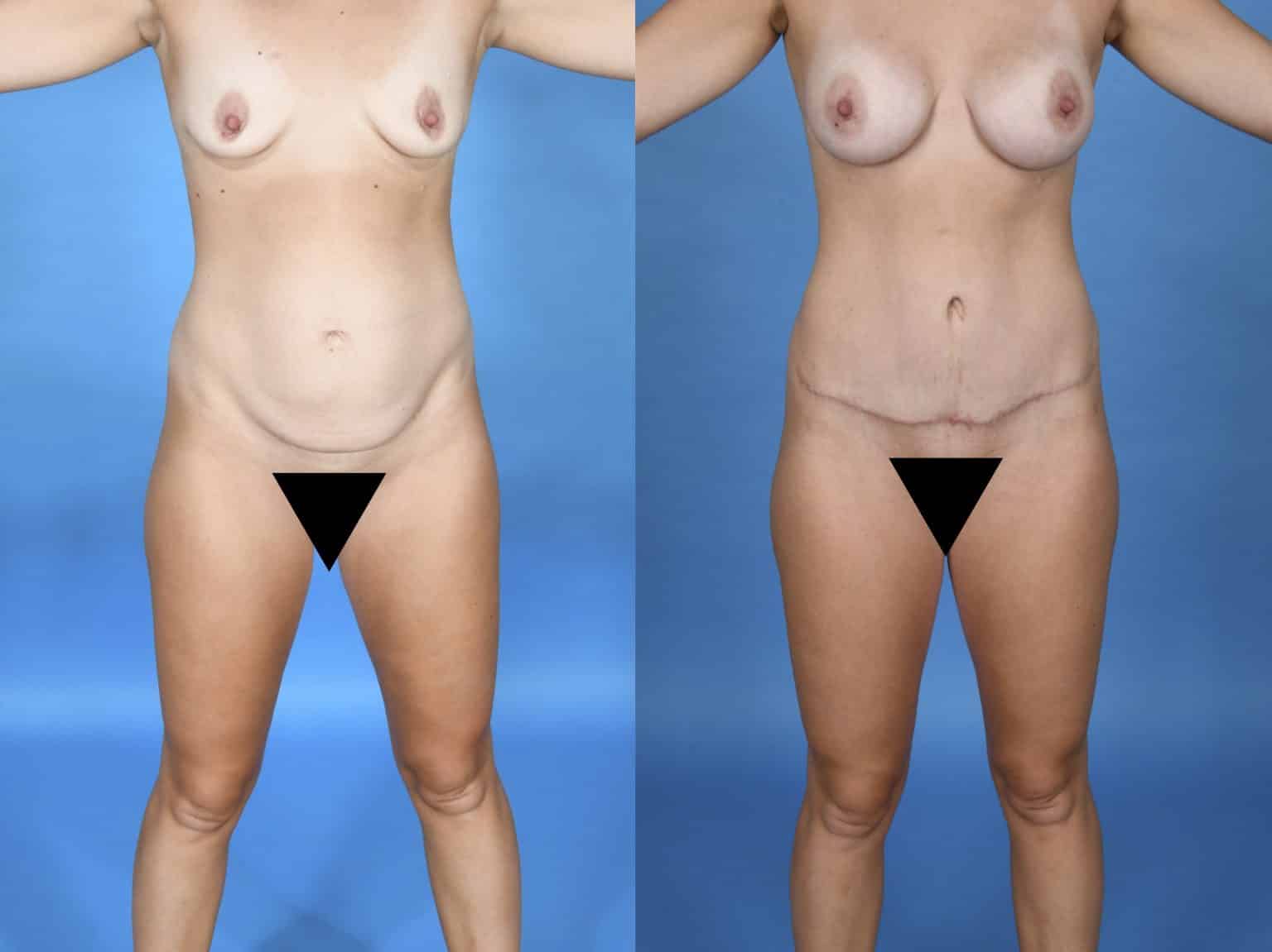 Before and After Image: Body Contouring - front