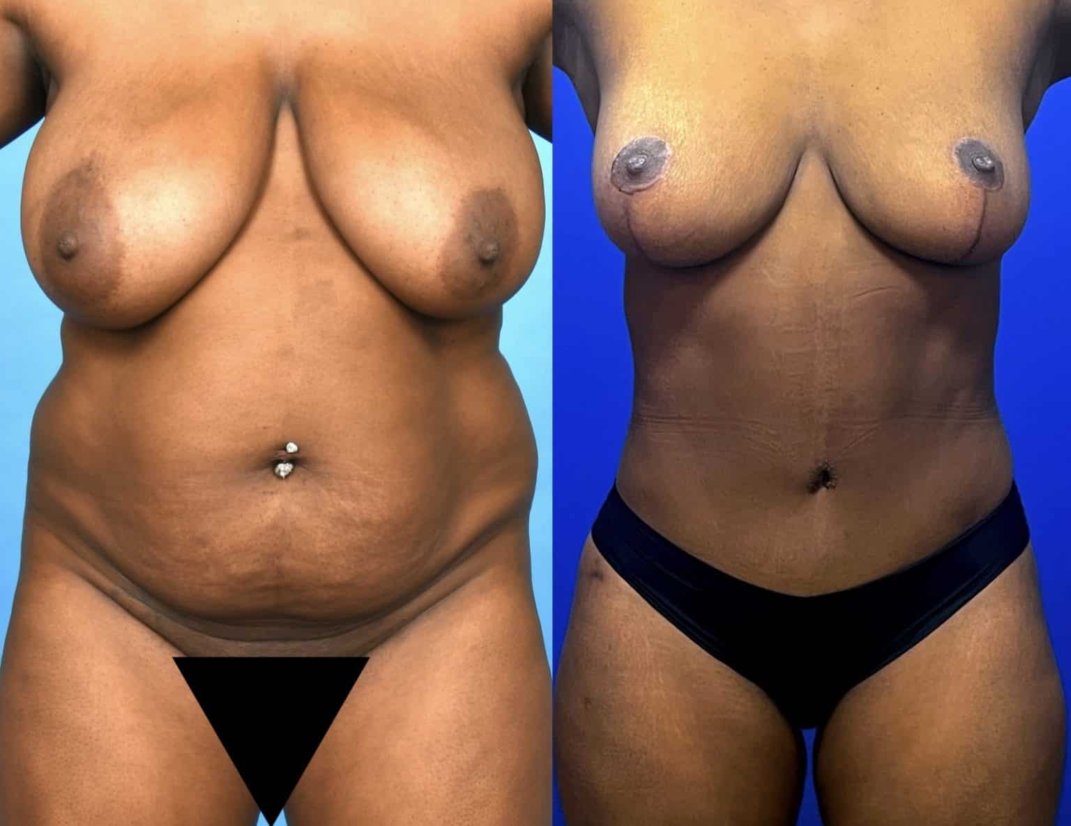 Before and After Image: Body Contouring - front