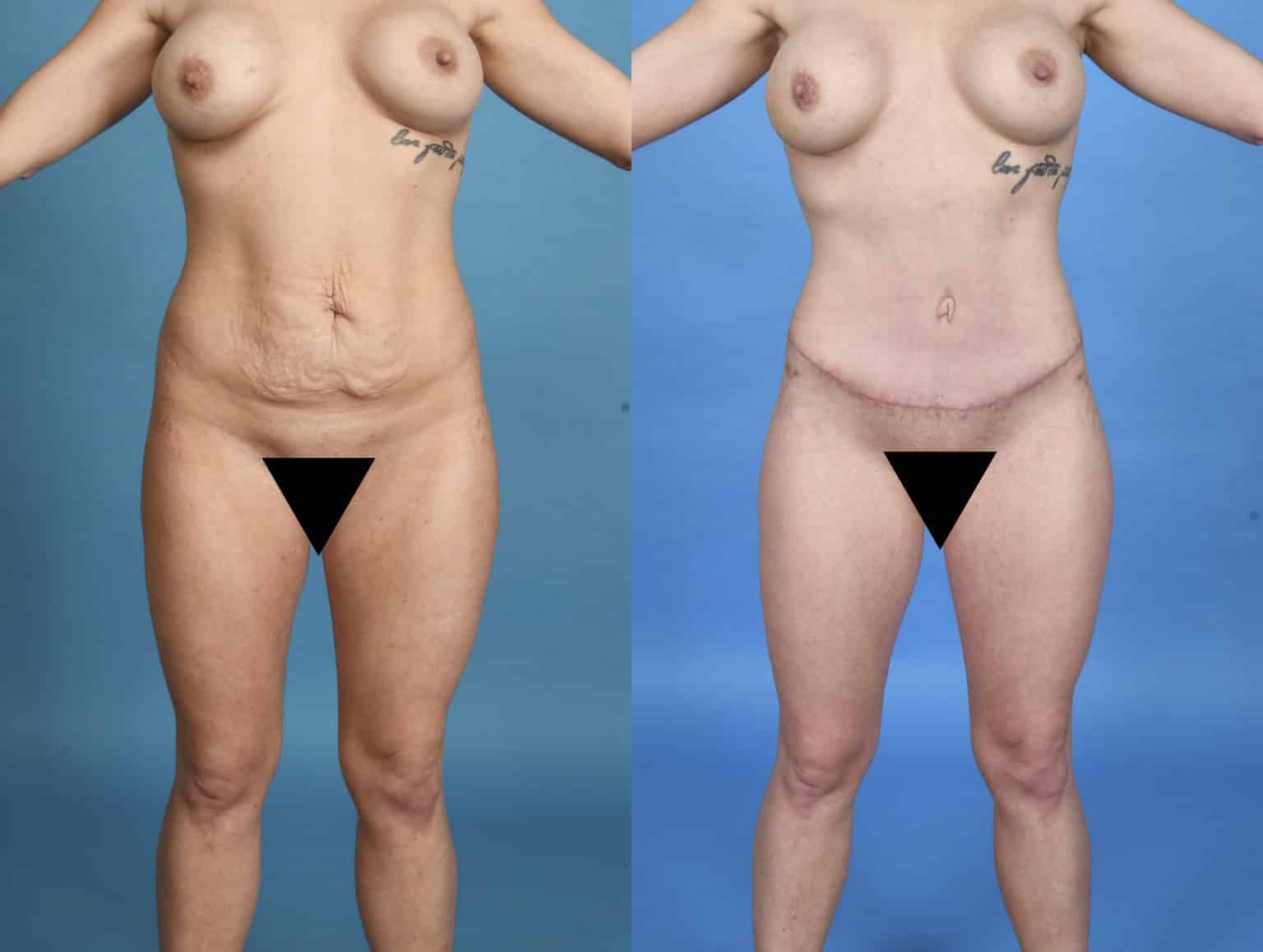 Before and After Image: Body Contouring - front