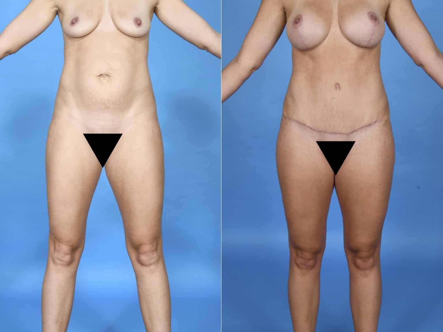 Before and After Image: Body Contouring - front