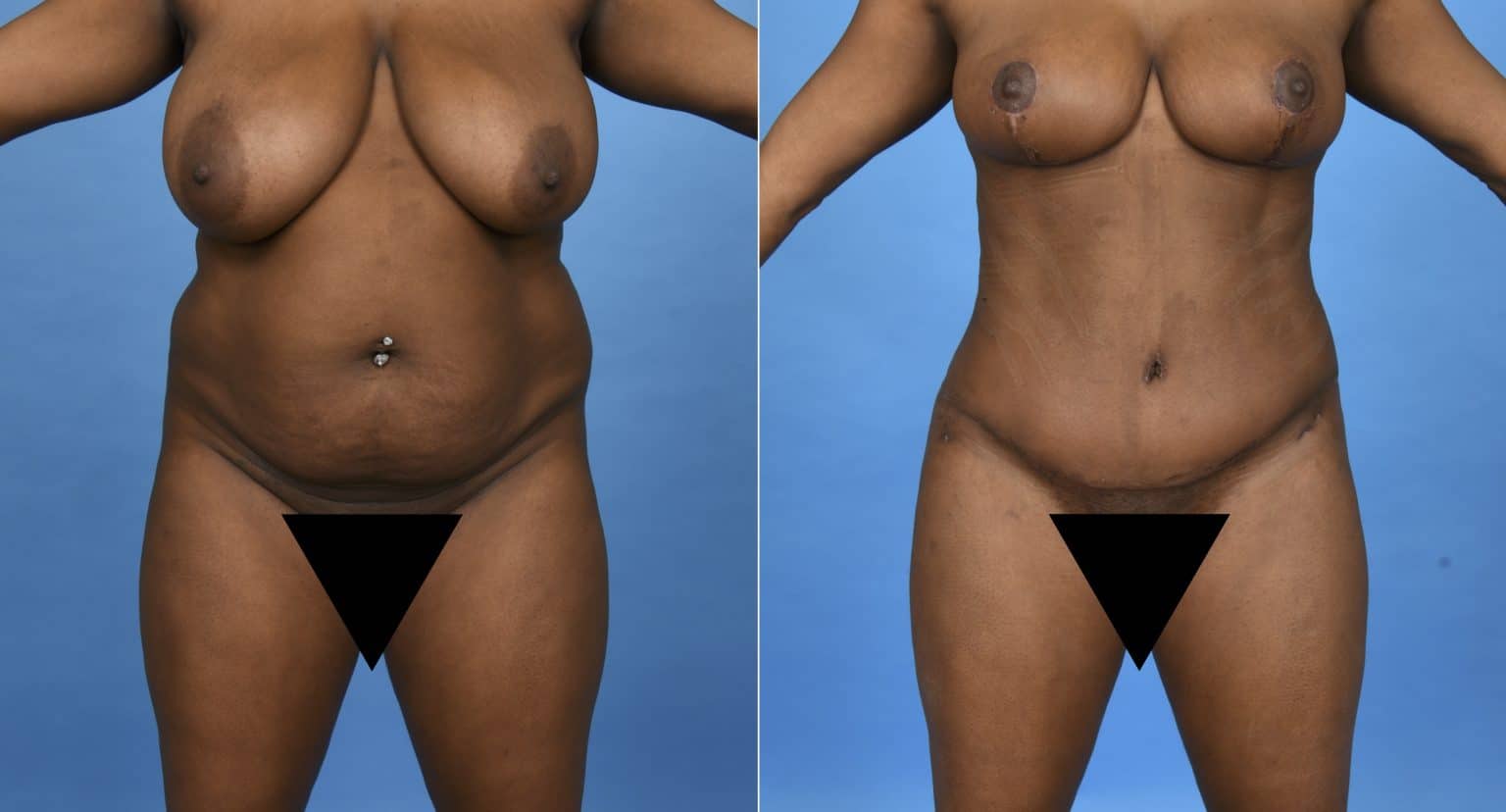 Before and After Image: Body Contouring - front