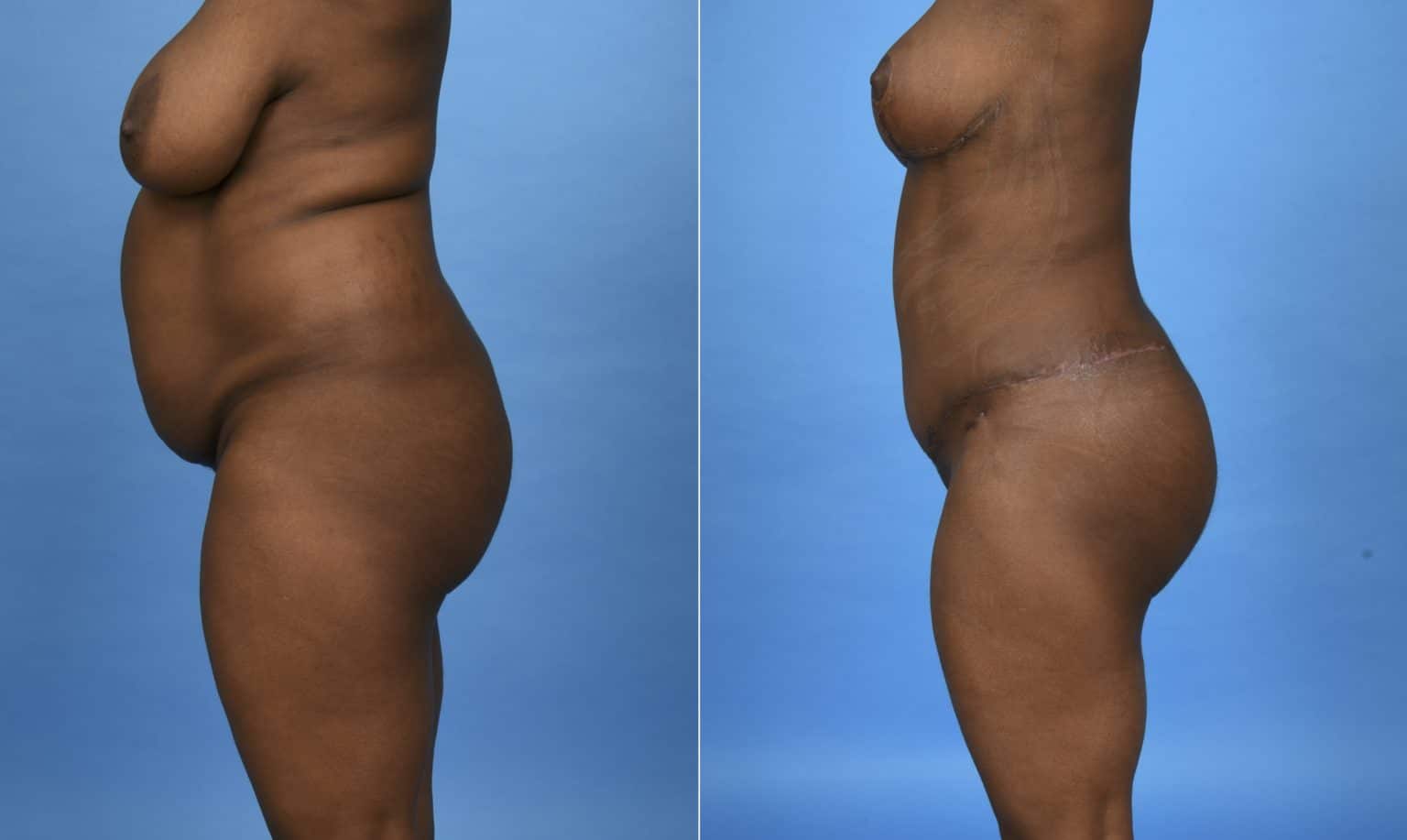 Before and After Image: Body Contouring - left-side
