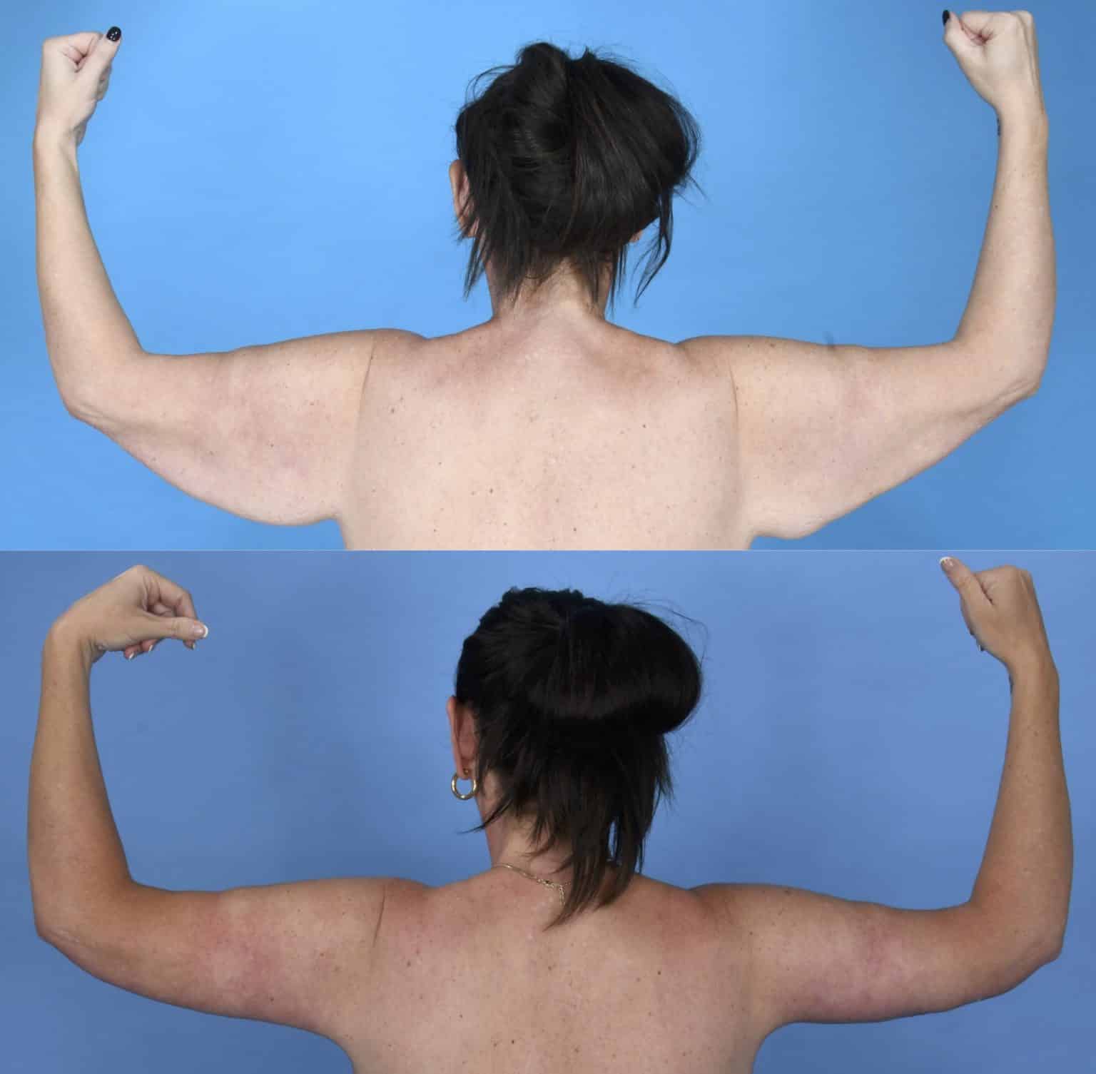 Before and After Image: Body Contouring - back