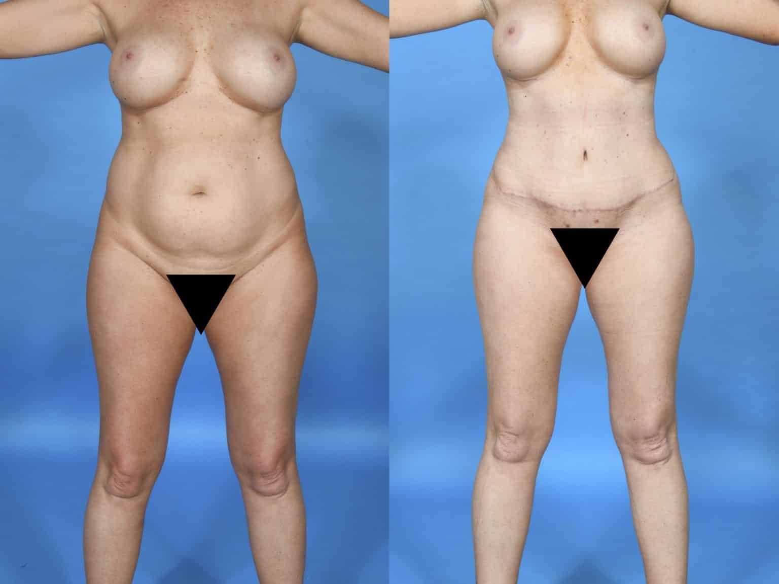 Before and After Image: Body Contouring - front